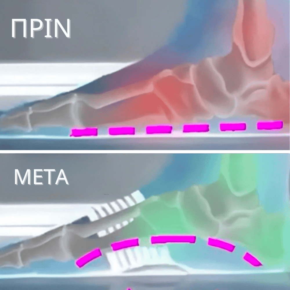 Υποστήριξη ποδικής καμάρας OrthoPies™