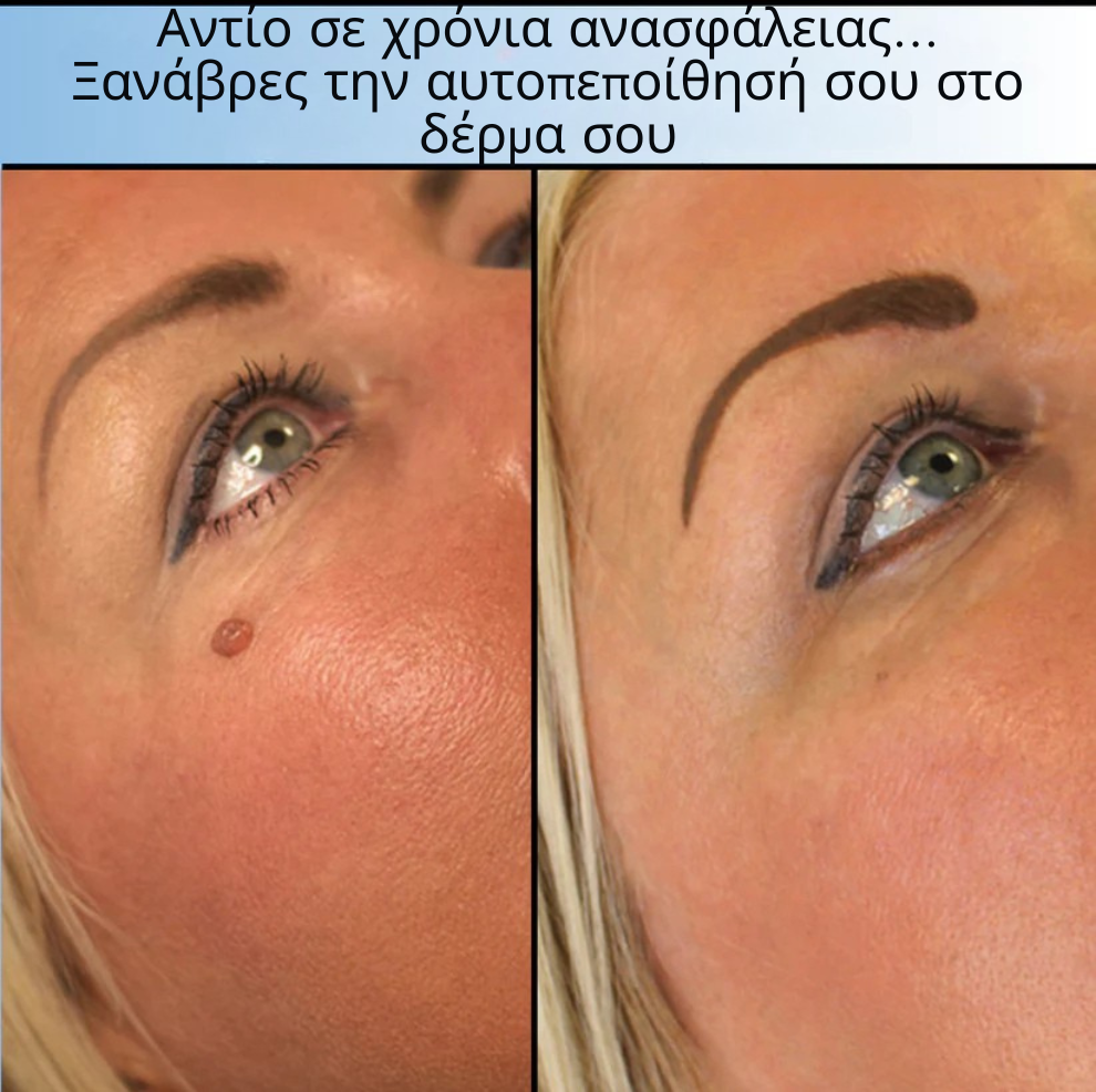 TagOFF Kit – Τέλος στα Θηλώματα Δέρματος