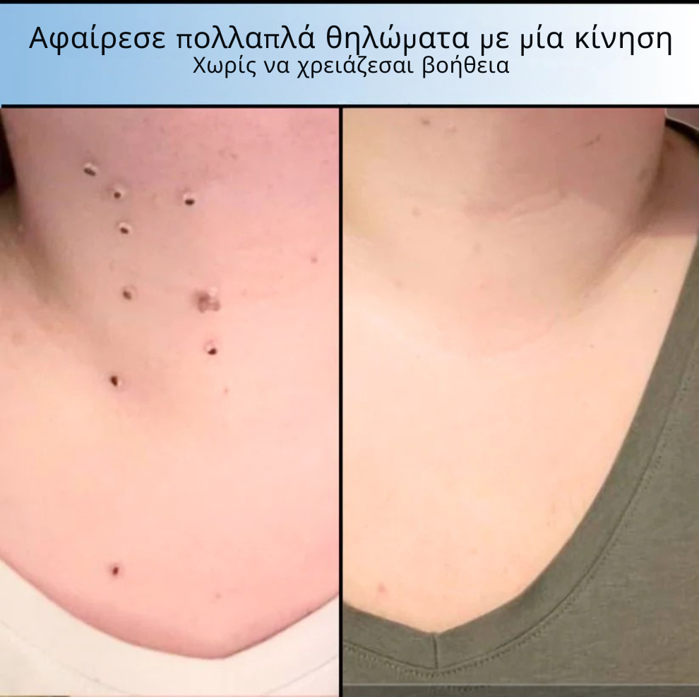 TagOFF Kit – Τέλος στα Θηλώματα Δέρματος